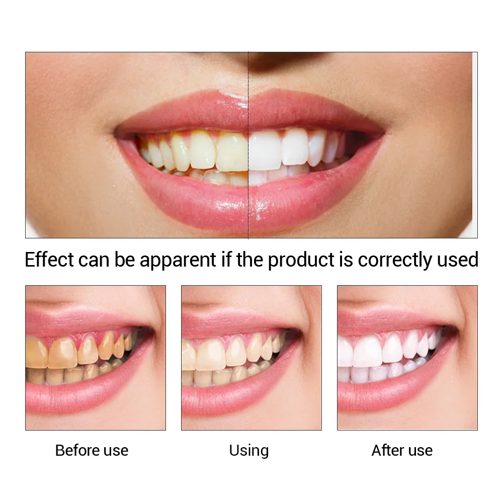 FTEENPLY Teeth Whitening Essen – Teeth Whitening Serum Bewertung und Preis