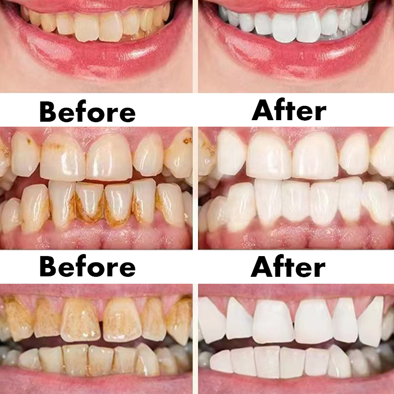 Teeth Whitening Pen Dental Ess – Teeth Whitening Serum Bewertung und Preis